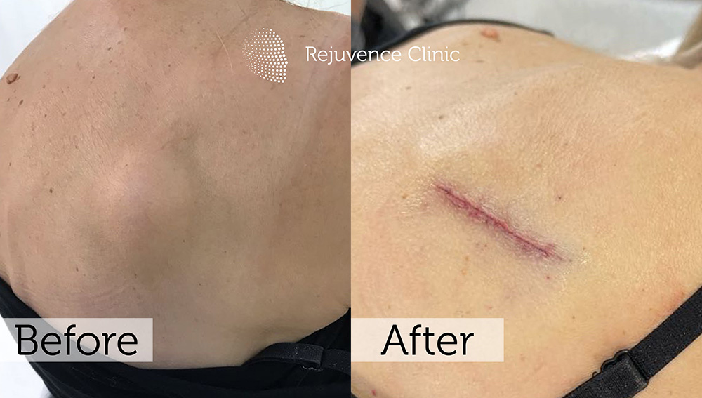 Lipoma Removal London | Rejuvence Clinic 30 21