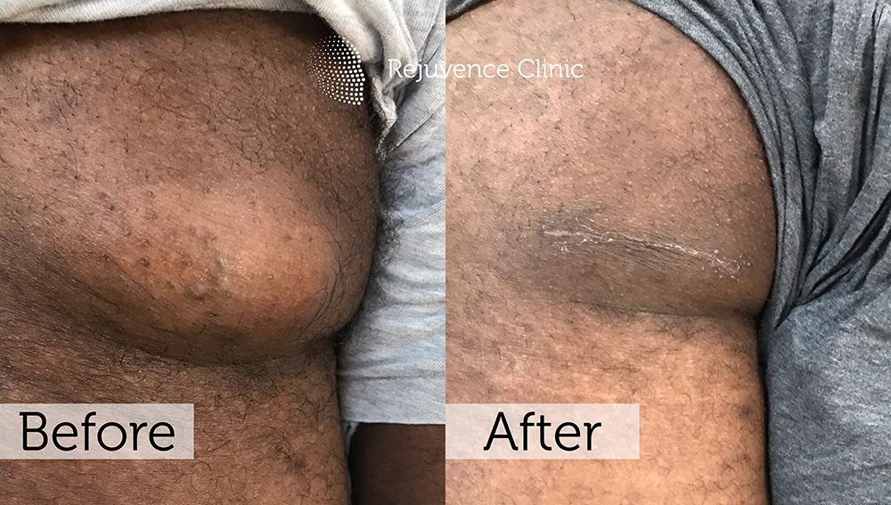 Lipoma Removal London | Rejuvence Clinic 34 23
