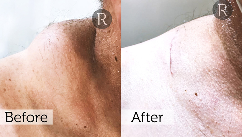 Lipoma Removal London | Rejuvence Clinic 35 24
