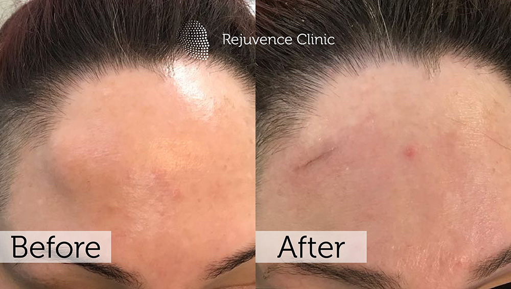 Lipoma Removal London | Rejuvence Clinic 6 3