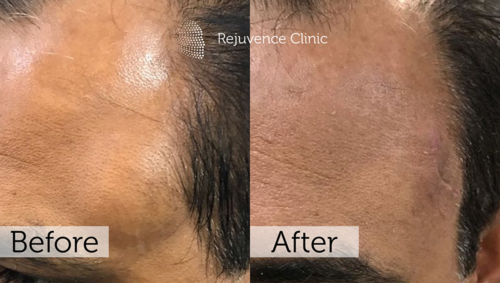 Lipoma Removal London | Rejuvence Clinic 7 4