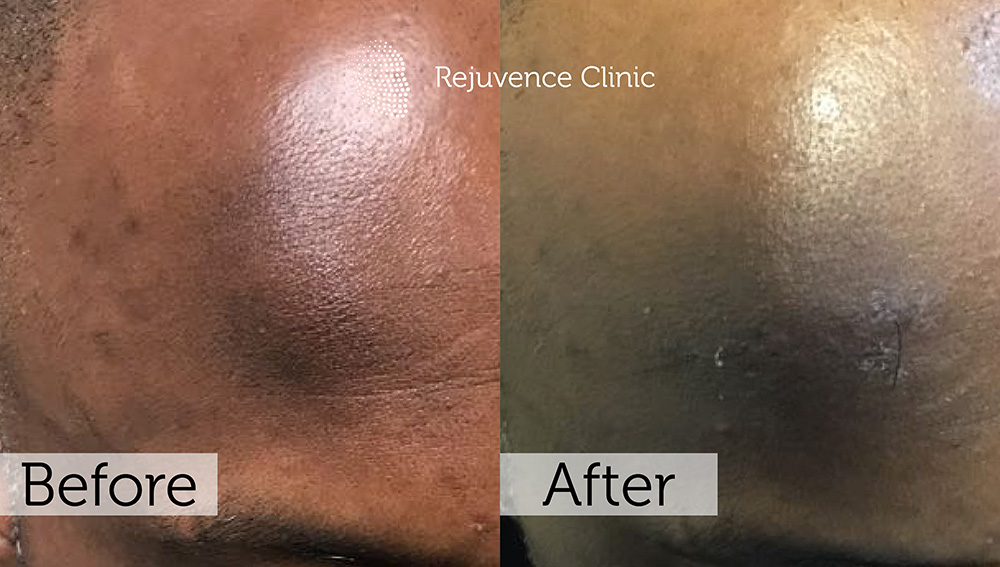 Lipoma Removal London | Rejuvence Clinic 8 5