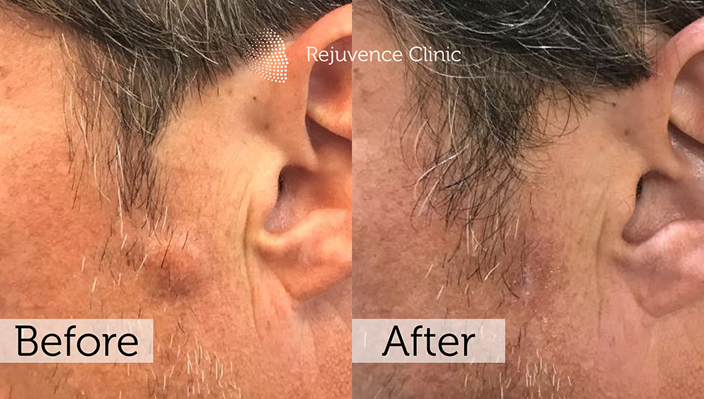 Lipoma Removal London | Rejuvence Clinic 9 6