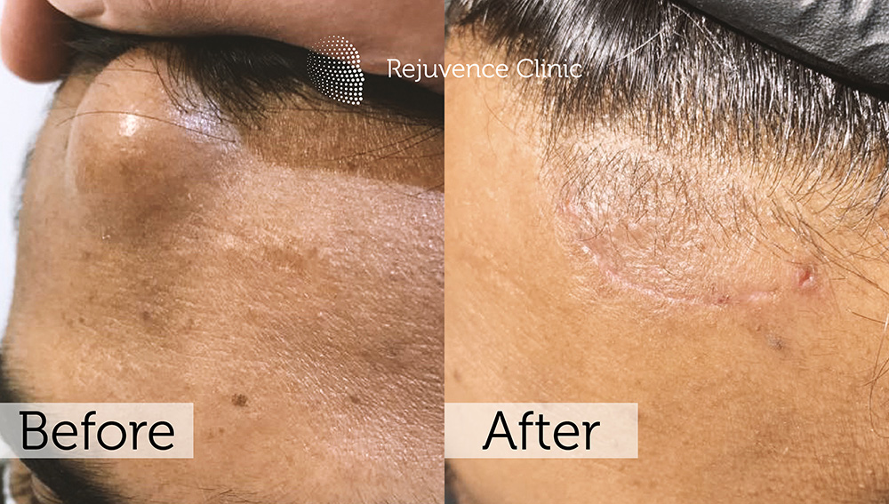 Lipoma Removal London | Rejuvence Clinic 10 7