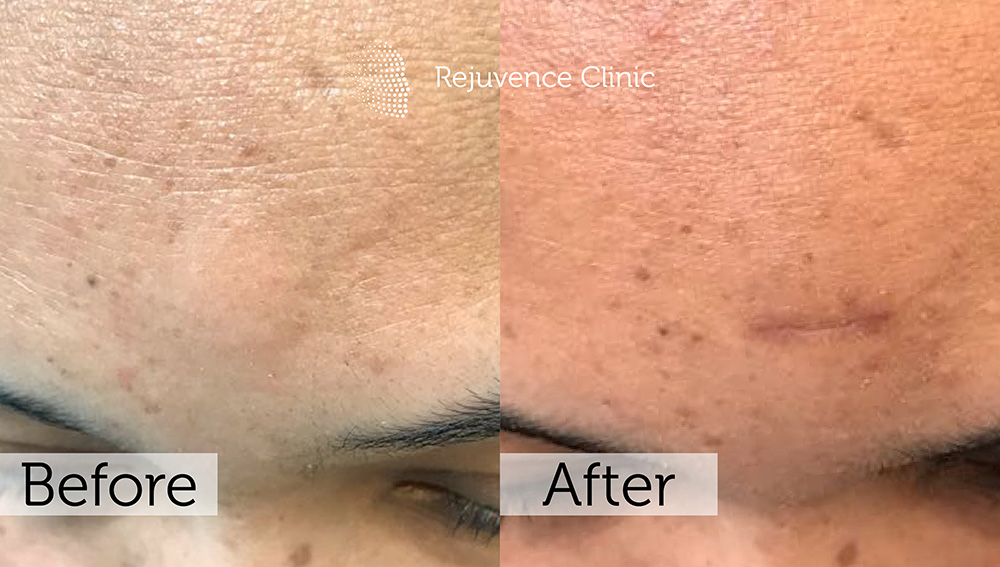 Lipoma Removal London | Rejuvence Clinic 11 8