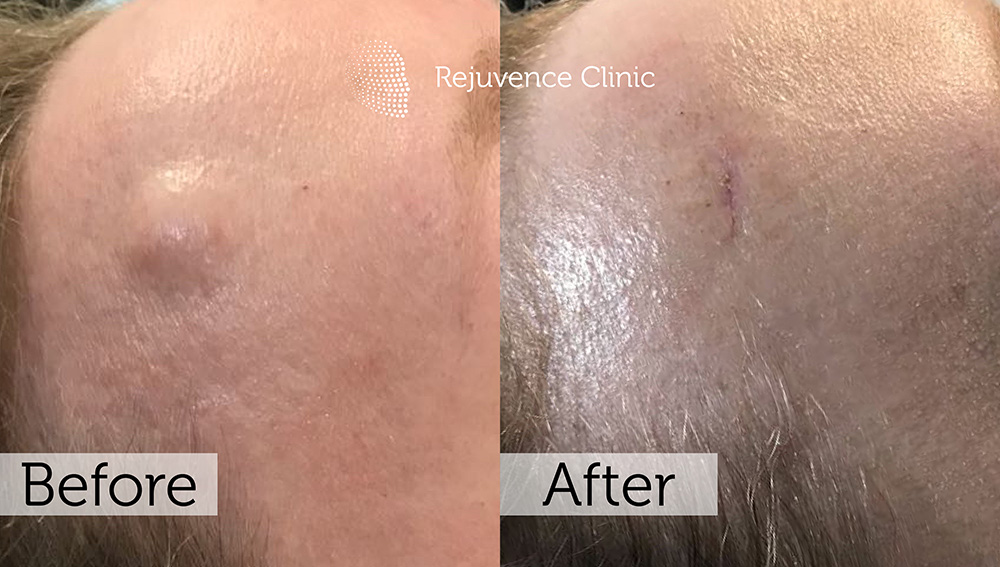 Lipoma Removal London | Rejuvence Clinic 12 9