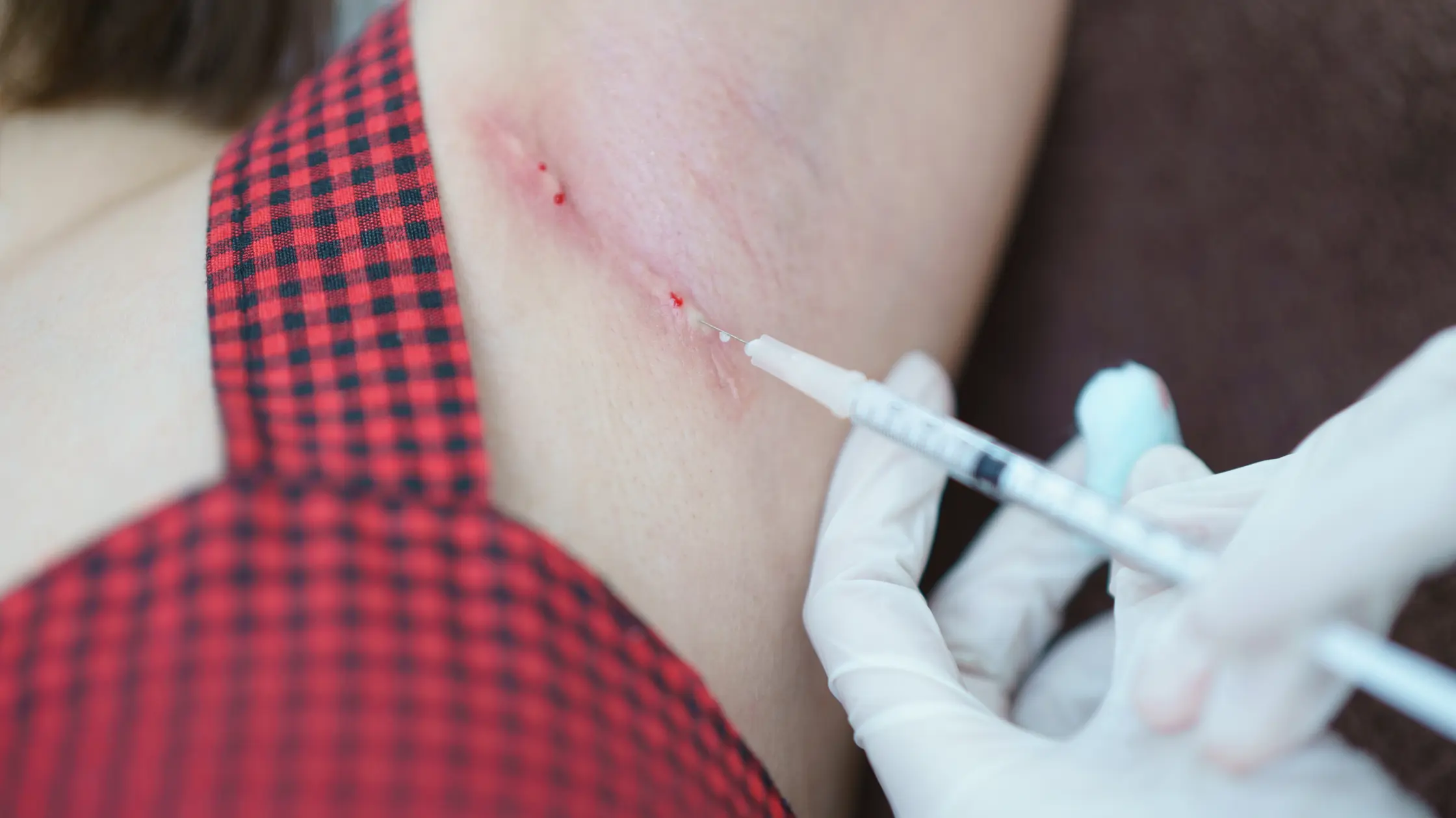 Are Keloids Common in the UK 1