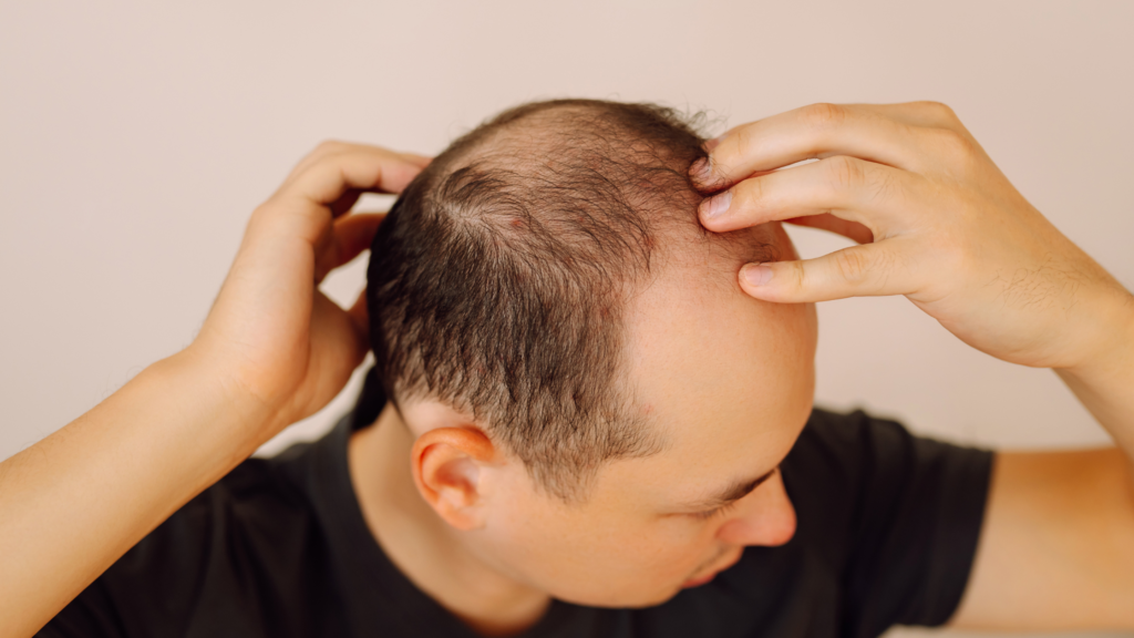 Can PRP Help If Hair Loss Runs in Your Family? 2 Can PRP Help If Hair Loss Runs in Your Family