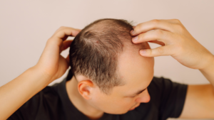 Can PRP Help If Hair Loss Runs in Your Family