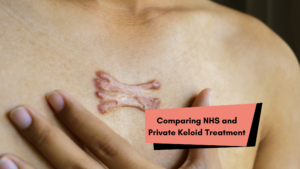 Can the NHS Treat Keloids? What UK Patients Should Know 3 Comparing NHS and Private Keloid Treatment 1