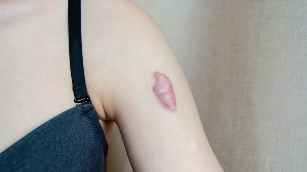Are Keloids Permanent A Guide from Doctor