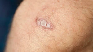 Europe's Leading Skin & Hair Clinic | Keloid Specialist | Rejuvence Clinic 10 Do Keloids Change Colour Over Time