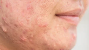 Europe's Leading Skin & Hair Clinic | Keloid Specialist | Rejuvence Clinic 10 Keloid Vs Normal Scar What Is the Difference 1