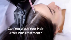 Europe's Leading Skin & Hair Clinic | Keloid Specialist | Rejuvence Clinic 10 Can You Wash Your Hair After PRP Treatment 1 1