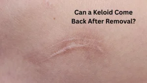 Can a Keloid Come Back After Removal