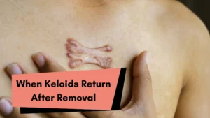 When Keloids Return After Removal